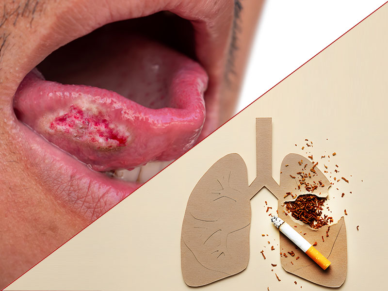  Tobacco & Oral Cancer: The Hidden Dangers | Dr. Tushar Patil | MOC Kalyani Nagar